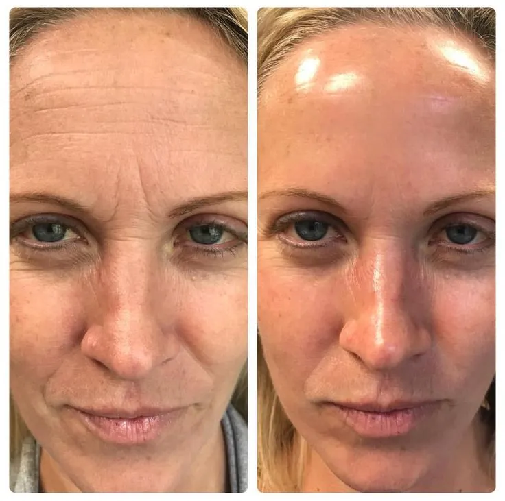 Vorher-Nachher Hydrafacial, Stirnfalten