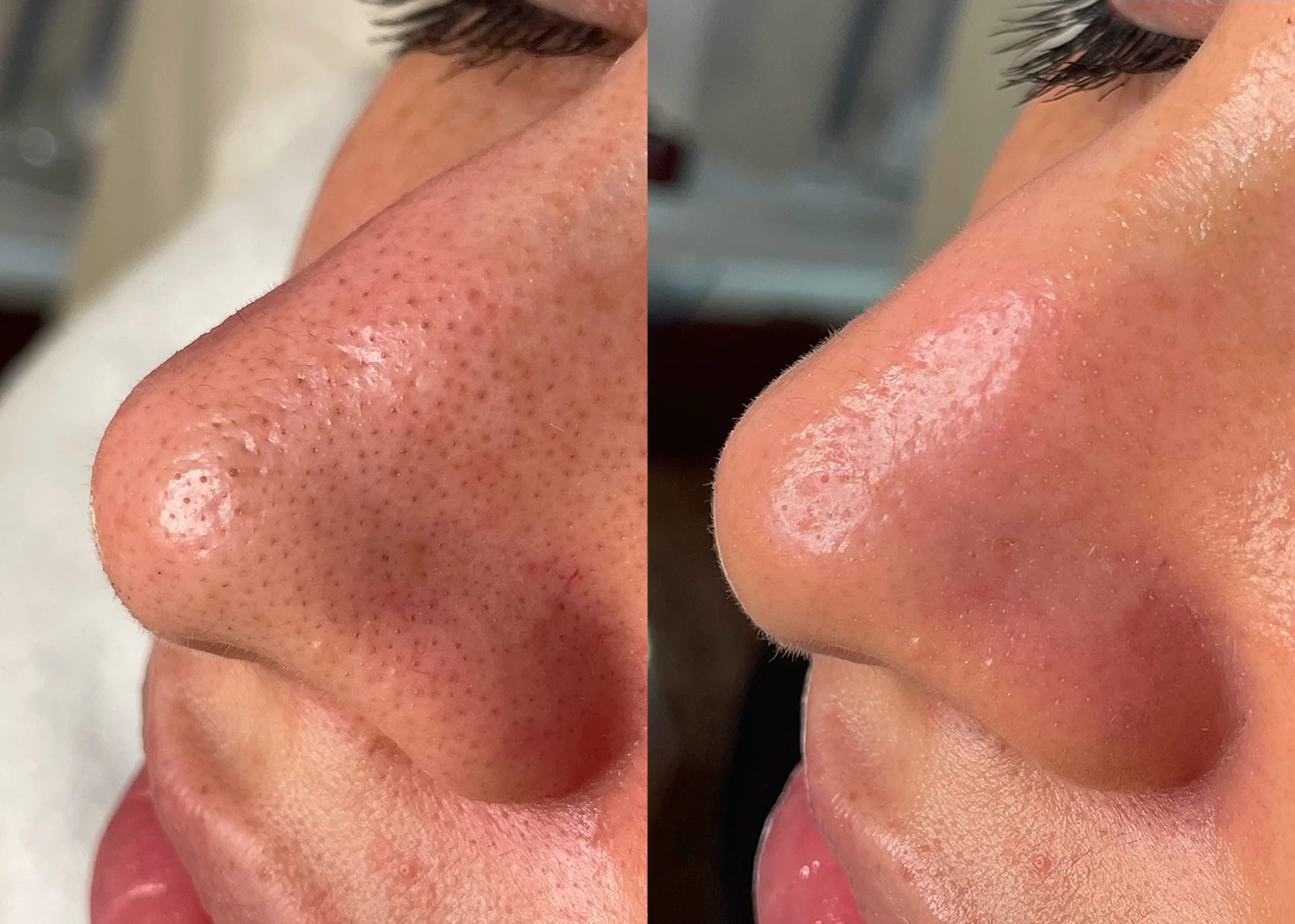 Vorher-Nachher Hydrafacial, Nasenporen