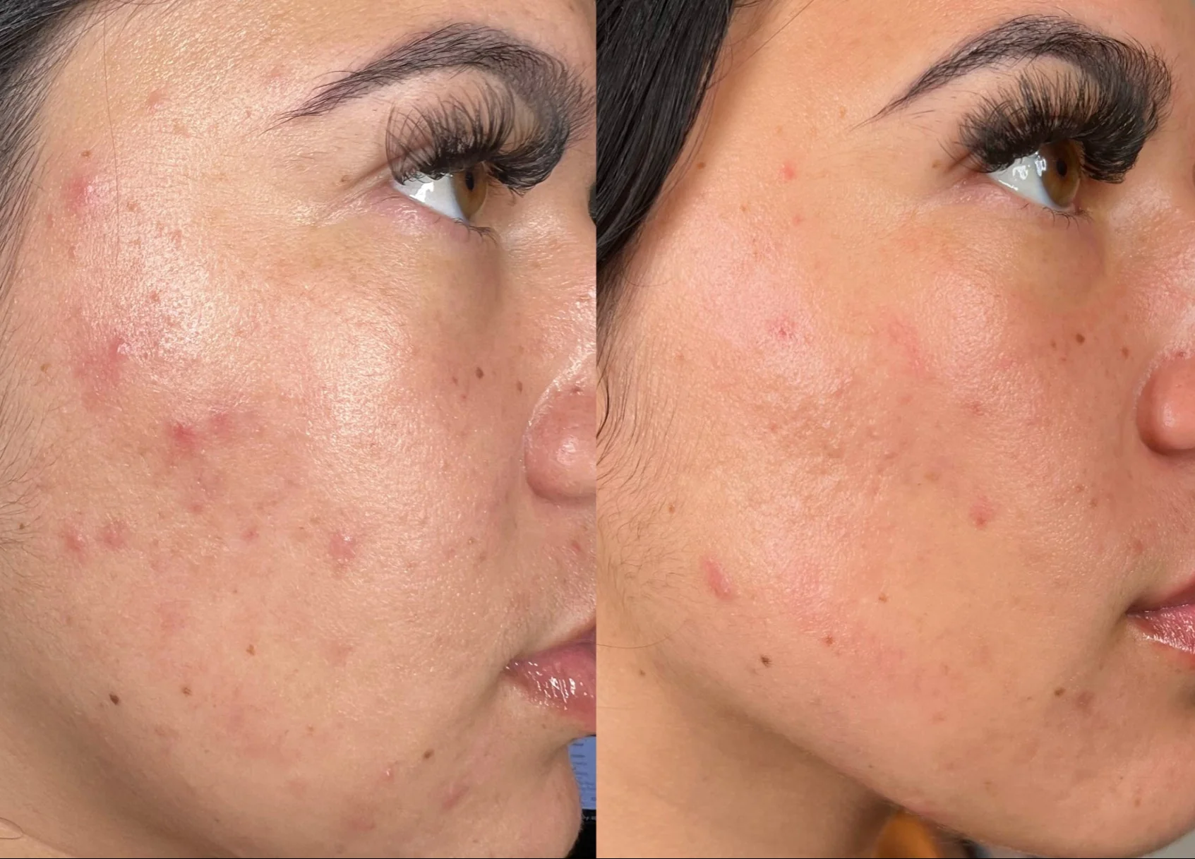 Vorher-Nachher Hydrafacial, Wangen-Hautbild