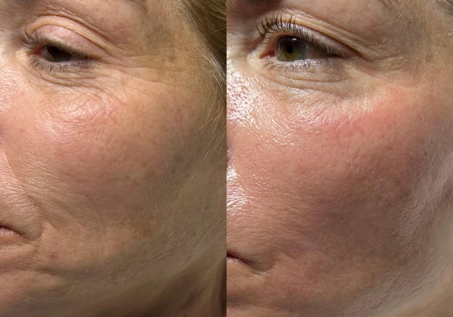 Vorher-Nachher Hydrafacial, Augenpartie