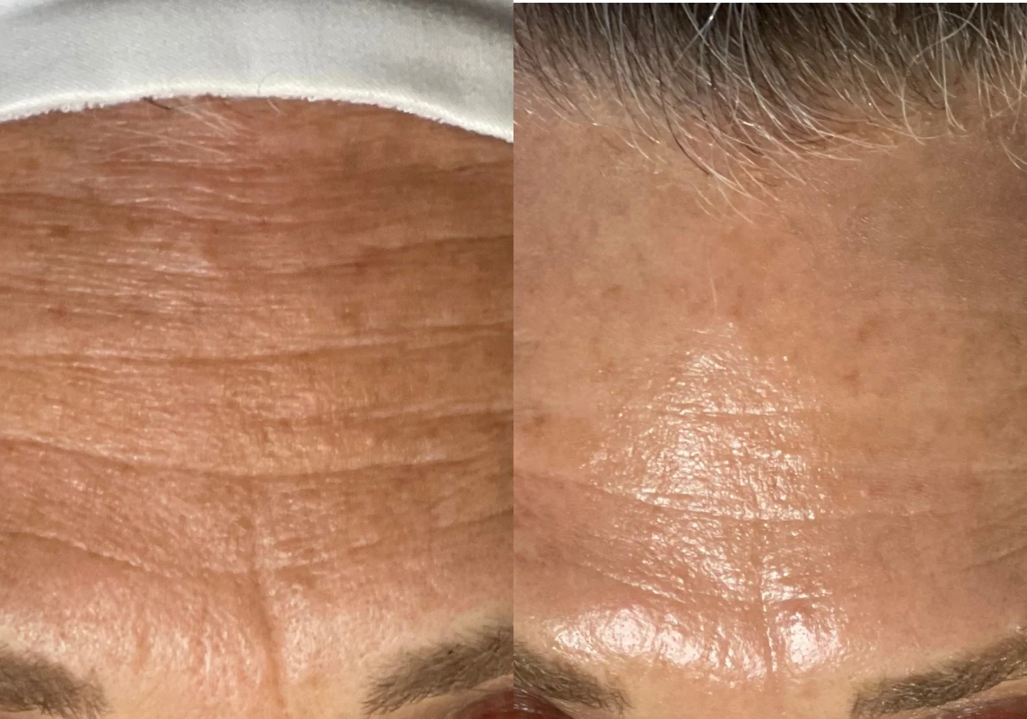 Vorher-Nachher Hydrafacial, Stirnpartie