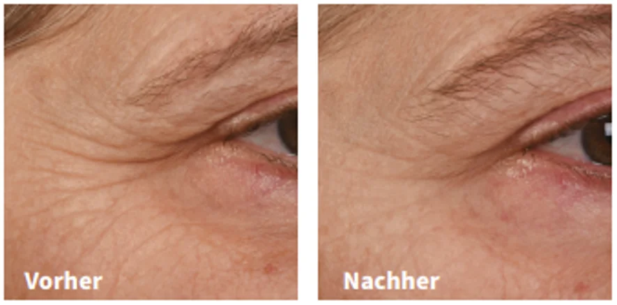Vorher-Nachher SkinPen, Augenpartie