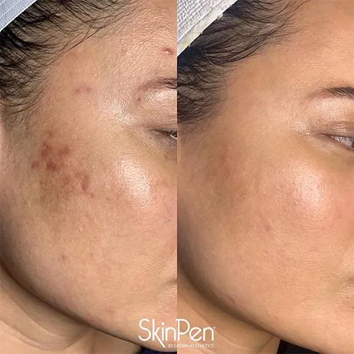 Vorher-Nachher SkinPen, Hautbild Wange (Herstellerbeispiel)