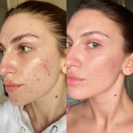 Vorher-Nachher SkinPen, Akne und Rötungen