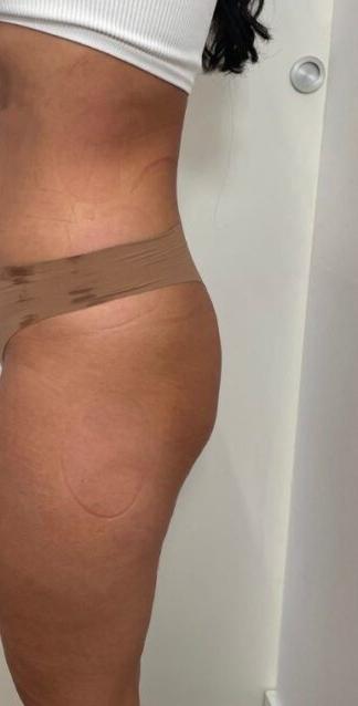 Nachher: Taille und Hüfte seitlich